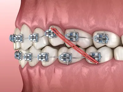 illustration of braces with elastic bands